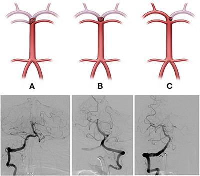 Occlusion type and posterior communicating artery patency may predict favorable outcome after endovascular thrombectomy in selective basilar top occlusion